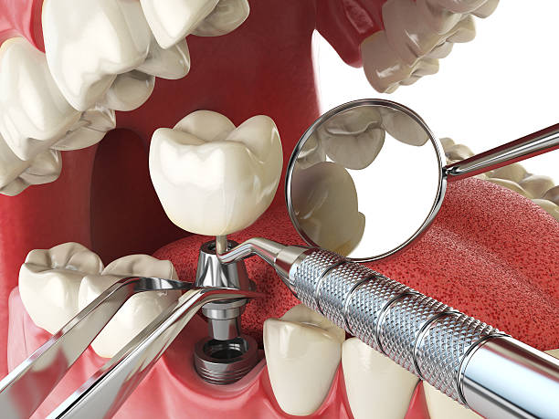 Best Emergency Root Canal Therapy in Twin Falls, ID